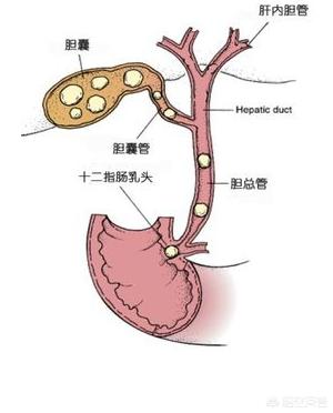 今日科普一下！胆囊藏400多颗结石,百科词条爱好_2024最新更新