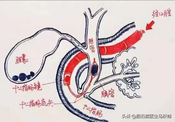 今日科普一下！胆囊藏400多颗结石,百科词条爱好_2024最新更新